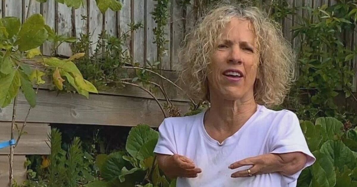 Gardeners' World Sue Kent left with 'massive scar' after accident off-camera