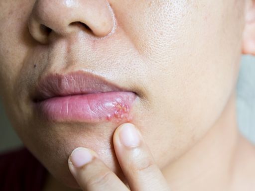 皰疹原因：汗皰疹、唇皰疹、帶狀皰疹？治療、藥膏差在哪？原來這種能打疫苗