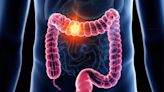 At-Home Colon Cancer Test Proves Just As Effective as a Colonoscopy