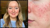 Trust us, there's still so much you need to know about rosacea