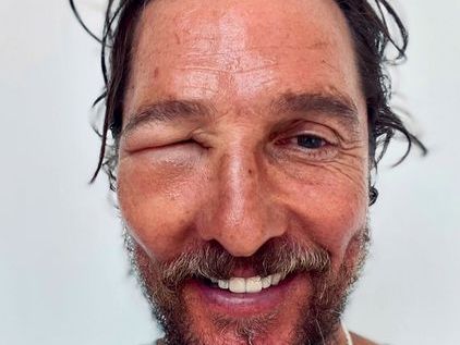 Matthew McConaughey shows off his swollen eye: 'Bee swell'