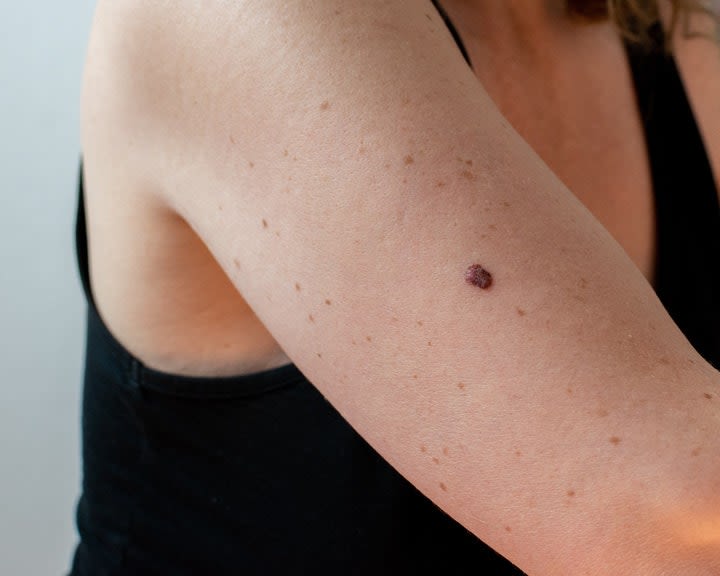 3 Types of Skin Cancer That Should Be on Everyone's Radar