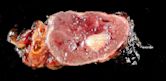 Pheochromocytoma