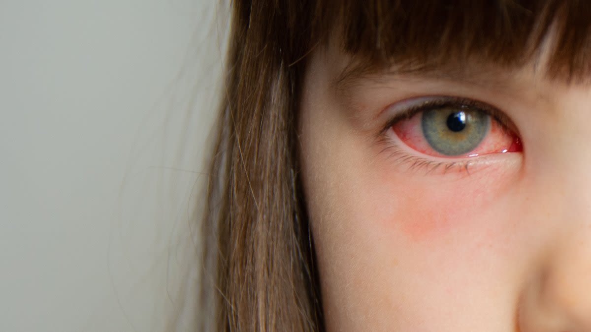 Doctors are prescribing antibiotics for pink eye despite guidelines that discourage their use