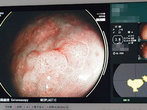 AI內視鏡檢查揪出可疑瘜肉 大腸癌無所遁形