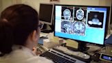 La enfermedad de Alzheimer progresa más rápido en las personas con síndrome de Down