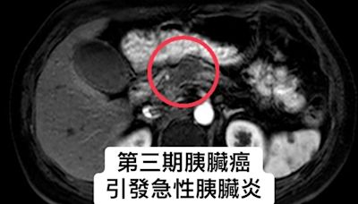 胃痛才知胰臟癌！60歲婦無症狀 確診已3期