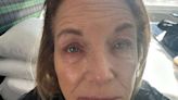 Katie Couric Shows Eczema Flare-Up in Vulnerable Photo: 'It Just Flares Up a Lot and It’s So Annoying!'