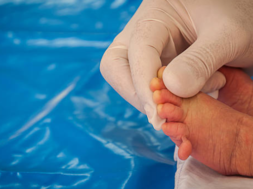 Baby born with Polydactyly condition, has 25 fingers and toes: Know why this happens in newborns - Times of India