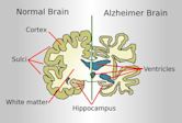 Alzheimer's disease