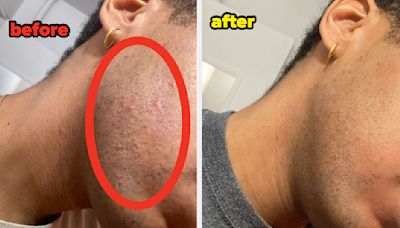 I Haven't Clean-Shaven My Face In Three Years Because I've Struggled With Ingrown Hairs, So I Tried This Hair Tonic...