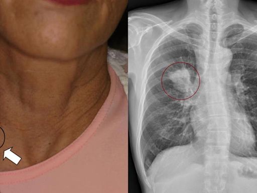50歲男脖子「一顆硬硬的」竟是癌！ 醫示警：痛不痛是關鍵│TVBS新聞網