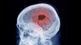 New Research Links Popular Hormone Drugs to Brain Tumors