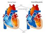 Overriding aorta