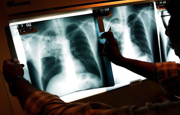 Tuberculosis in California: Outbreak declared in Long Beach, 1 dead, 9 hospitalized