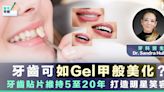 【牙齒美容】牙齒都可以Gel甲般美化 牙齒貼片維持5至20年 打造明星般笑容