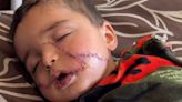 One-year-old gets 200 facial stitches and hand amputation in Gaza