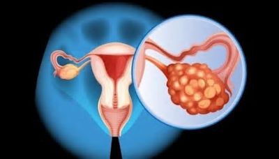 Hoy es el 'Día Mundial del Cáncer de Ovario'
