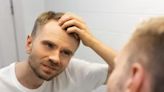 Male baldness is often trivialised – our research shows it should be taken seriously - EconoTimes