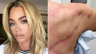 After 15 Surgeries for Melanoma, Teddi Mellencamp Faces Another: 'It's OK to Have Feelings and Be Afraid'