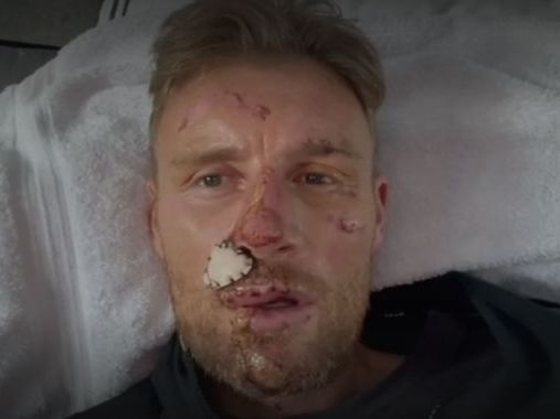 Freddie Flintoff reveals extent of injuries after Top Gear crash