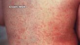 Healthwatch: Dr. Taylor Kapsch speaks on the effects of measles