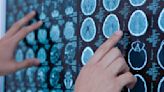 IQ-AI shares jump as therapy offered to brain tumour patients