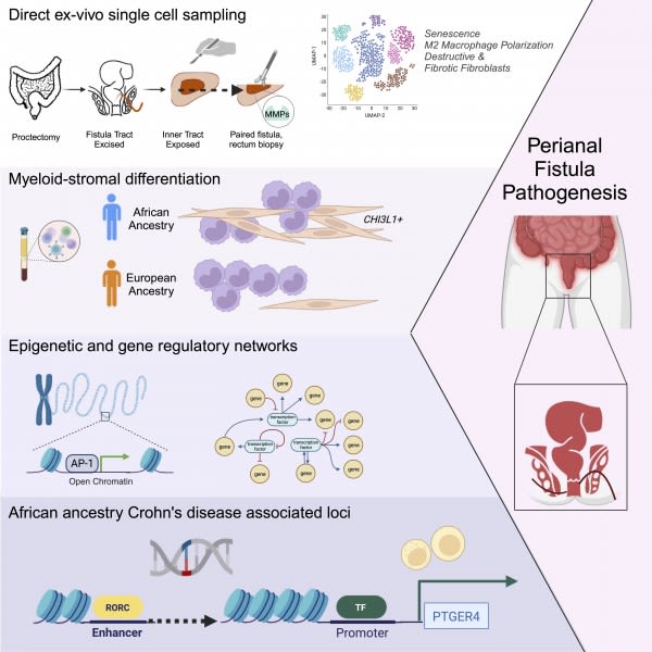 Mount Sinai Researchers the First to Apply Single-Cell Analysis to Reveal Mechanisms of a Common Complication of Crohn’s Disease