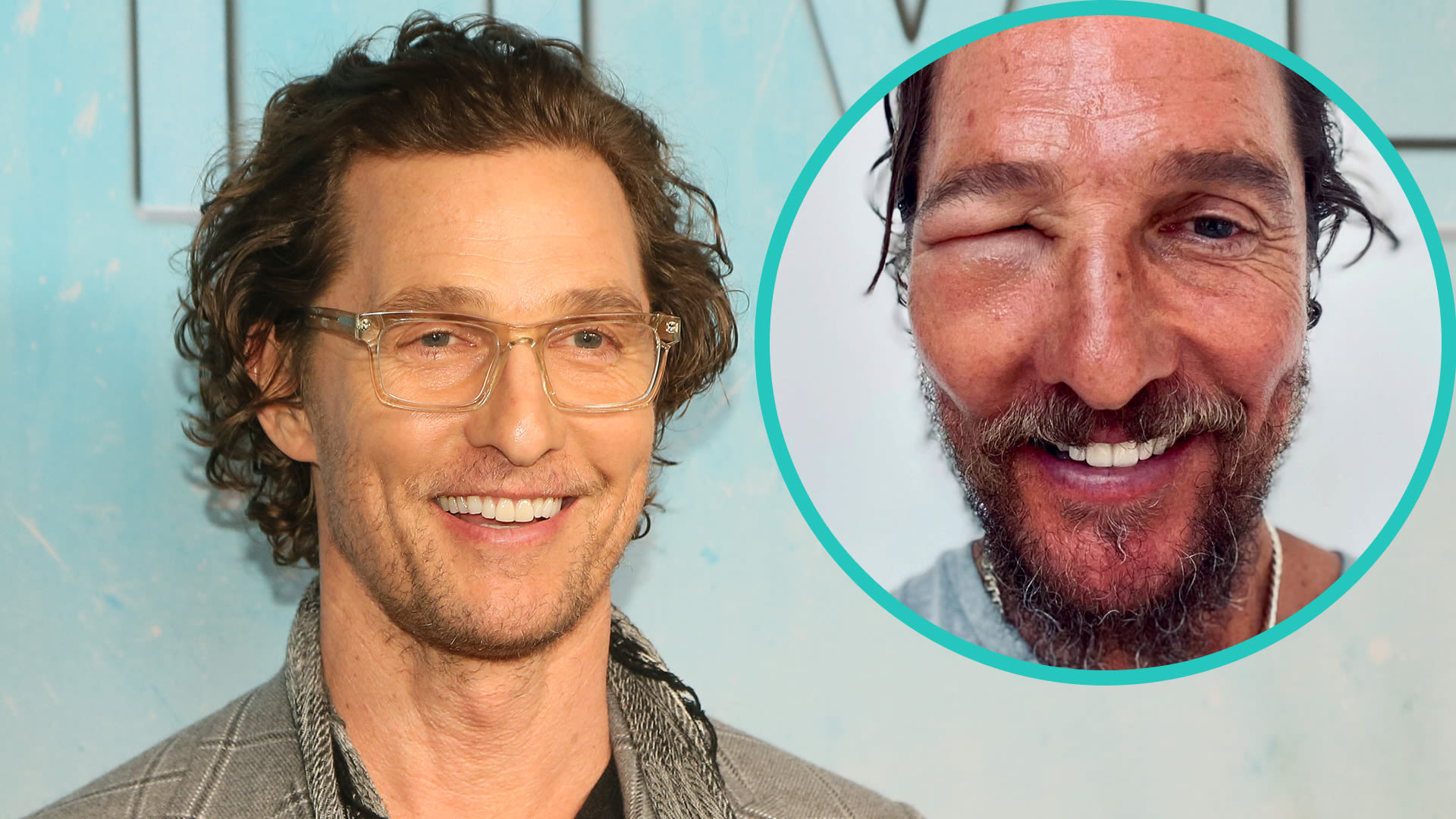 Matthew McConaughey's Eye Swells Shut In Startling Bee Sting Photo