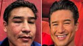 Mario Lopez Shares Before-and-After Photos of His 'Busted' Eye from Jiu-Jitsu Injury: 'Makeup Magic'