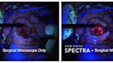 ... Myriad SPECTRA™ System as a 'Game-Changing Advancement' in Surgical Removal of High-Grade Glioma Brain Tumors