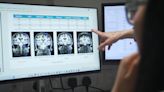 New AI tool could be game-changer in battle against Alzheimer's