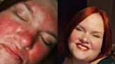 Woman dubbed a ‘tomato’ because of ‘misunderstood’ skin condition