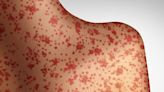 Second contagious case of measles reported in Montreal: public health