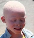 Albinism in humans