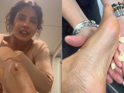 Priyanka Chopra tries Indian ‘nuskha’ of rubbing garlic on feet after suffering injuries on film set in Australia. See pics, videos