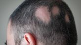 Alopecia areata: las incógnitas que abre la pastilla milagrosa contra un tipo de calvicie