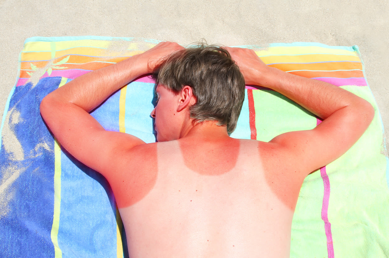 Your Sunburn May Require Medical Attention — Here Are The 2 Major Signs It Does