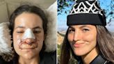 Brooklinn Khoury Shares Graphic Photos of Her Nose After Dog Attack: 'Hard to Believe'