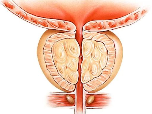 73歲老台商「攝護腺肥大」忍8年拖成癌！醫一看：腫瘤已穿透攝護腺