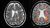 Early treatment could slow the onset of multiple sclerosis symptoms, study finds