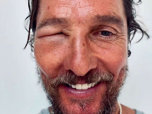 Matthew McConaughey Shocks Fans with His Swollen Eye: 'Bee Swell'