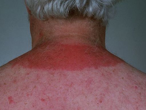 Hell’s Itch: How to Find Relief From Severe Sunburn Itch