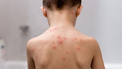 More than 90% of chickenpox cases in New York City outbreak among unvaccinated people