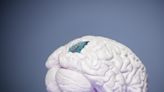 Neuralink: lo que hay detrás y el futuro de los implantes cerebrales como el creado por Elon Musk