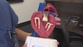 Evolving heart tech gives patients more options vs. open heart surgery