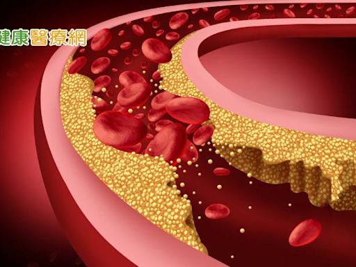 新研究：膽固醇太高竟會失智? 降到1數字可降低失智風險