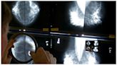 Mammogram guidance changing amid ‘younger and younger’ breast cancer diagnoses