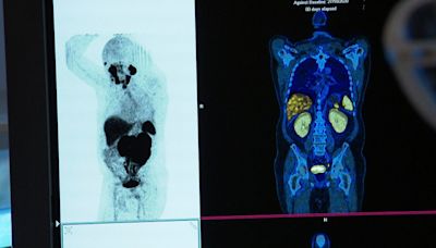 Drug trial offers prostate cancer patients new hope