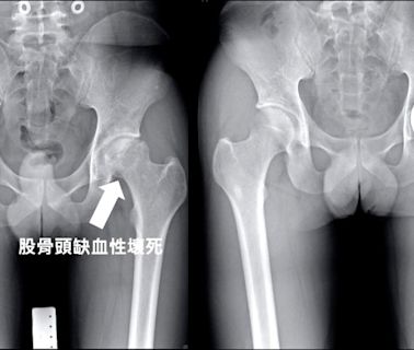 「微創」人工髖關節置換 不破壞主要肌肉 - 自由健康網